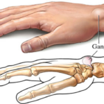 7 Alarming Effects of Reinke’s Oedema