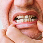 5 Signs of Gingivitis You Should Not Ignore