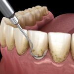 What Is a Periodontist? When to See a Gum Specialist