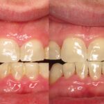 What Is Perio Maintenance? A Complete Guide to Gum Care