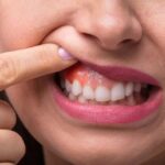 Natural Home Remedies To Reverse Gum Disease