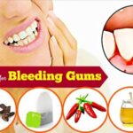 5 Signs of Gingivitis You Should Not Ignore