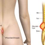 Understanding Lateral Periodontal Cysts: Causes, Diagnosis, and Treatment Options