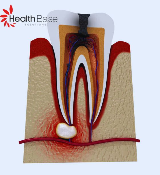 Lateral Periodontal Cysts