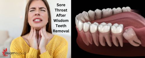 Sore Throat After Wisdom Teeth Removal