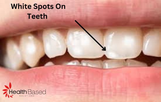 How to Get Rid of White Spots on Teeth