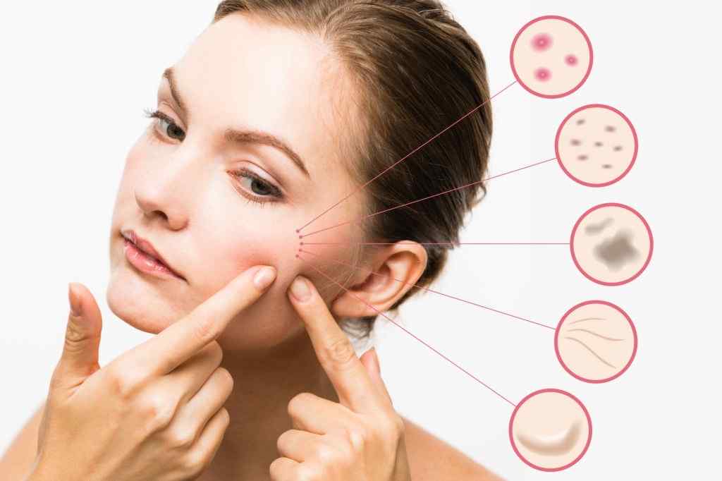 Acne happens when tiny openings on your skin, called pores, become clogged with oil and dead skin cells.